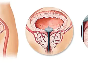  కోతలేకుండానే ప్రోస్టేట్‌కు పరిష్కారం