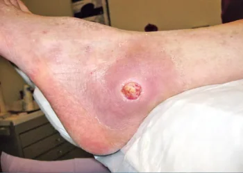 డయాబెటిస్ పేషంట్లకు గులాబీ రక్షణ