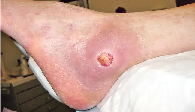 డయాబెటిస్ పేషంట్లకు గులాబీ రక్షణ