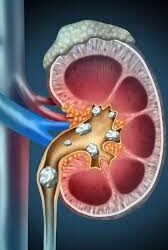 కిడ్నీలో రాళ్లు ఉన్నప్పుడు మూత్రంలో రక్తం ఎందుకు వస్తుంది.?